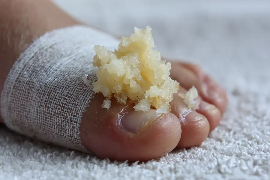 pasta czosnkowa do leczenia brodawek stóp naturalna